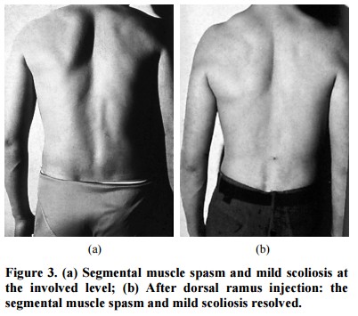 La Sindrome Del Ramo Dorsale nel mal di schiena Cosa sappiamo 003 spine center